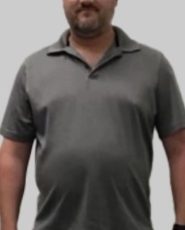 Patient photographed before his weight loss programme, front view