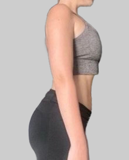 The same patient photographed after their weight loss programme, front view