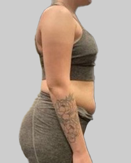 Third patient photographed before their weight loss programme, front view