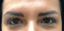 After treatment: a smooth, relaxed brow