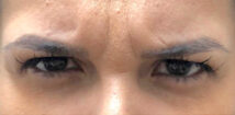 Before treatment: frown lines between the eyebrows