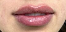 After treatment: fuller, more defined lips