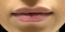 Before treatment: close-up of naturally thin lips