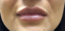 After treatment: a fuller lip line and smoother chin