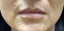 Before treatment: close-up of the mouth and chin