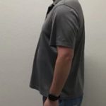 Weight Loss Before & After Patient #255