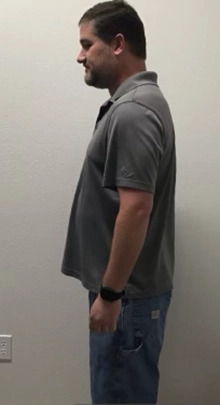 Patient #255 Weight Loss Before and After Photos San Marcos - Plastic