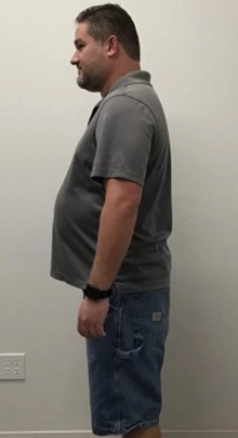 Weight Loss Before & After Patient #255