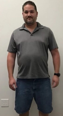 Weight Loss Before & After Patient #255
