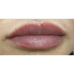 Lip Augmentation Before & After Patient #239