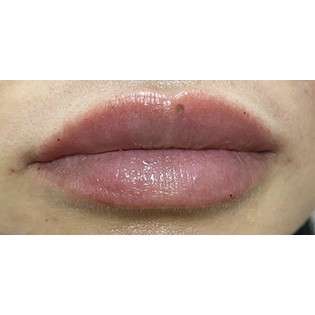 Lip Augmentation Before & After Patient #239