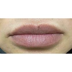 Lip Augmentation Before & After Patient #239