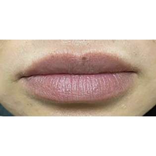 Lip Augmentation Before & After Patient #239
