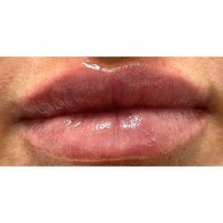 Lip Augmentation Before & After Patient #236