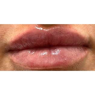 Lip Augmentation Before & After Patient #236
