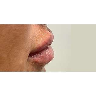 Lip Augmentation Before & After Patient #236