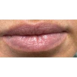 Lip Augmentation Before & After Patient #236