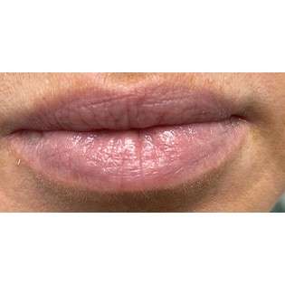 Lip Augmentation Before & After Patient #236