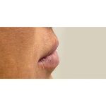 Lip Augmentation Before & After Patient #236