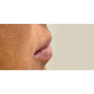 Lip Augmentation Before & After Patient #236