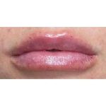 Lip Augmentation Before & After Patient #231