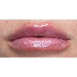 Lip Augmentation Before & After Patient #231