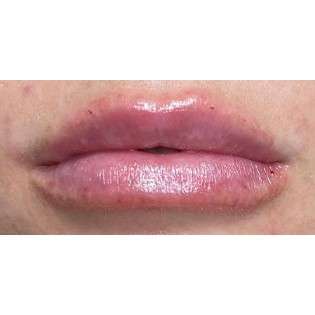 Lip Augmentation Before & After Patient #231