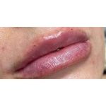 Lip Augmentation Before & After Patient #231