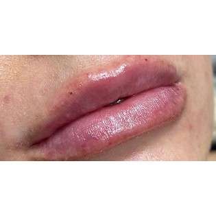 Lip Augmentation Before & After Patient #231