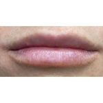 Lip Augmentation Before & After Patient #231