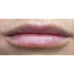 Lip Augmentation Before & After Patient #231