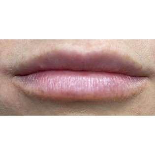 Lip Augmentation Before & After Patient #231