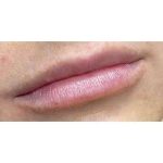 Lip Augmentation Before & After Patient #231