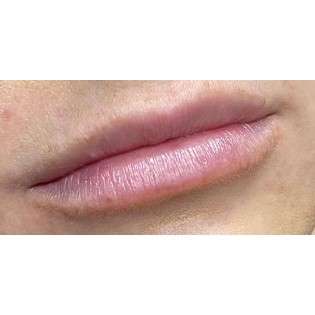 Lip Augmentation Before & After Patient #231