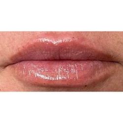 Lip Augmentation Before & After Patient #226