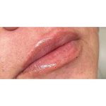 Lip Augmentation Before & After Patient #226