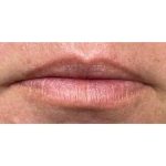 Lip Augmentation Before & After Patient #226