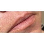 Lip Augmentation Before & After Patient #226