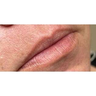 Lip Augmentation Before & After Patient #226