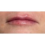 Lip Augmentation Before & After Patient #221