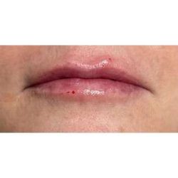 Lip Augmentation Before & After Patient #221