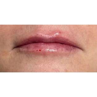 Lip Augmentation Before & After Patient #221