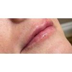 Lip Augmentation Before & After Patient #221