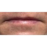 Lip Augmentation Before & After Patient #221