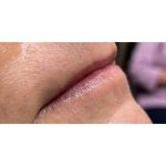 Lip Augmentation Before & After Patient #221
