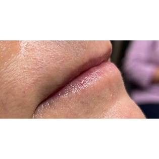 Lip Augmentation Before & After Patient #221