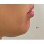 Jawline Chin Enhancement Before & After Patient #188