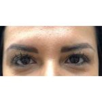 Botox Before & After Patient #180
