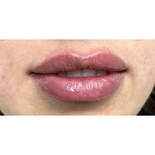 Lip Augmentation Before & After Patient #244