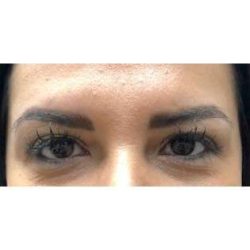 Botox Before & After Patient #180